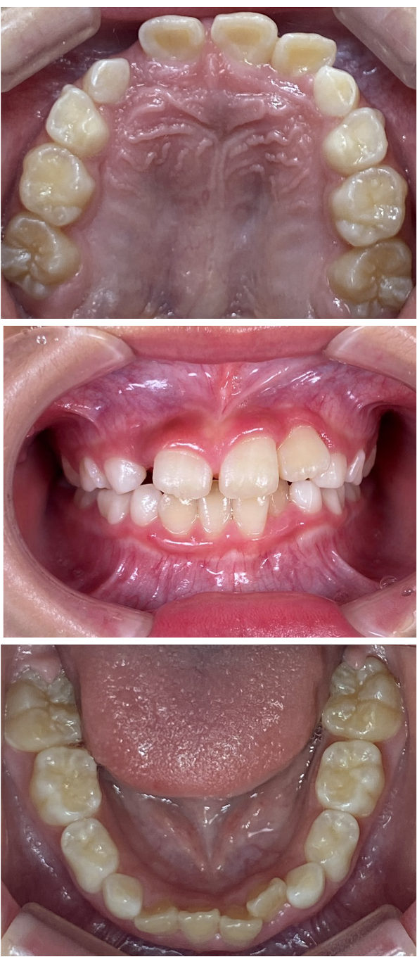 歯がガタガタに並んでいるのが気になる（叢生小児矯正症例）1