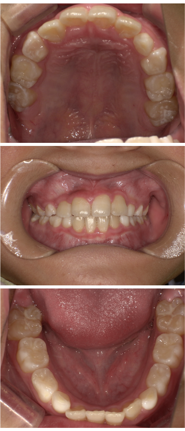 歯がガタガタに並んでいるのが気になる（叢生小児矯正症例）3