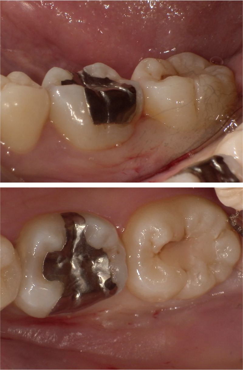 金属の詰め物の色が気になる1