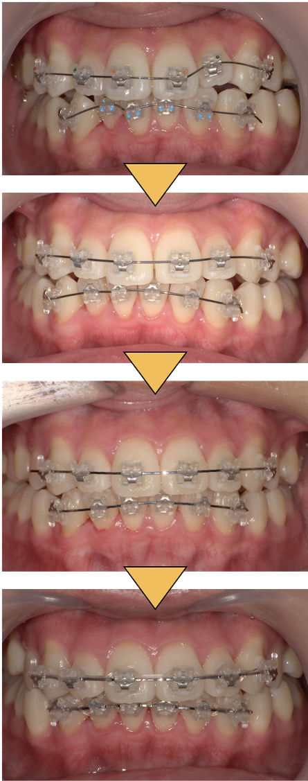 部分矯正で治療が可能かを知りたい（部分矯正症例）5