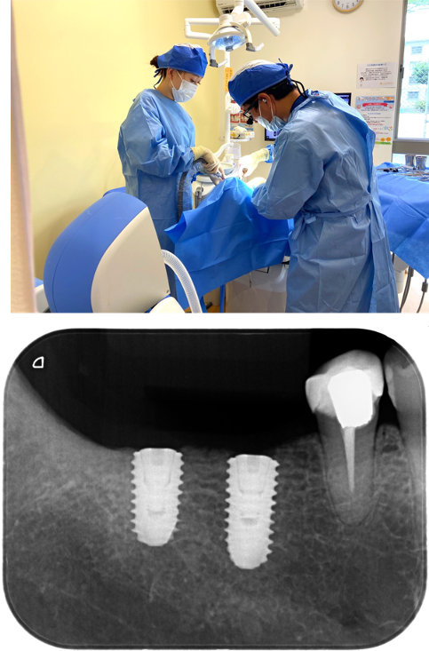 入れ歯が使えなくて他の方法を考えている（インプラント症例）5