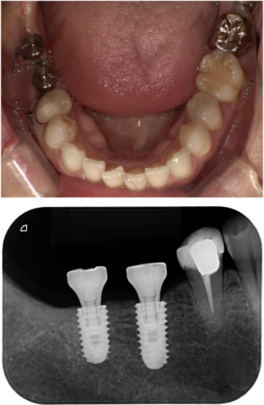 入れ歯が使えなくて他の方法を考えている（インプラント症例）6