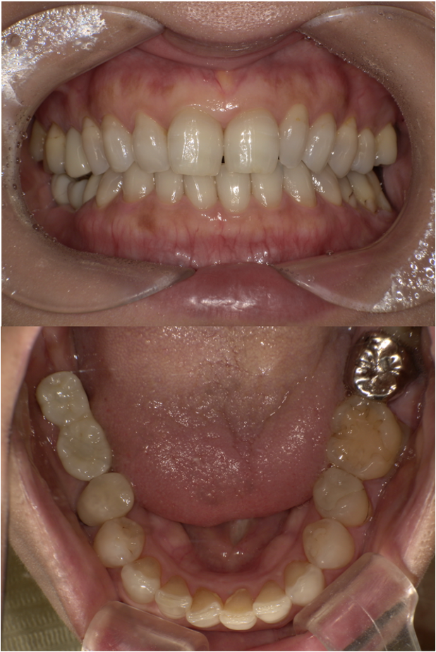 入れ歯が使えなくて他の方法を考えている（インプラント症例）3