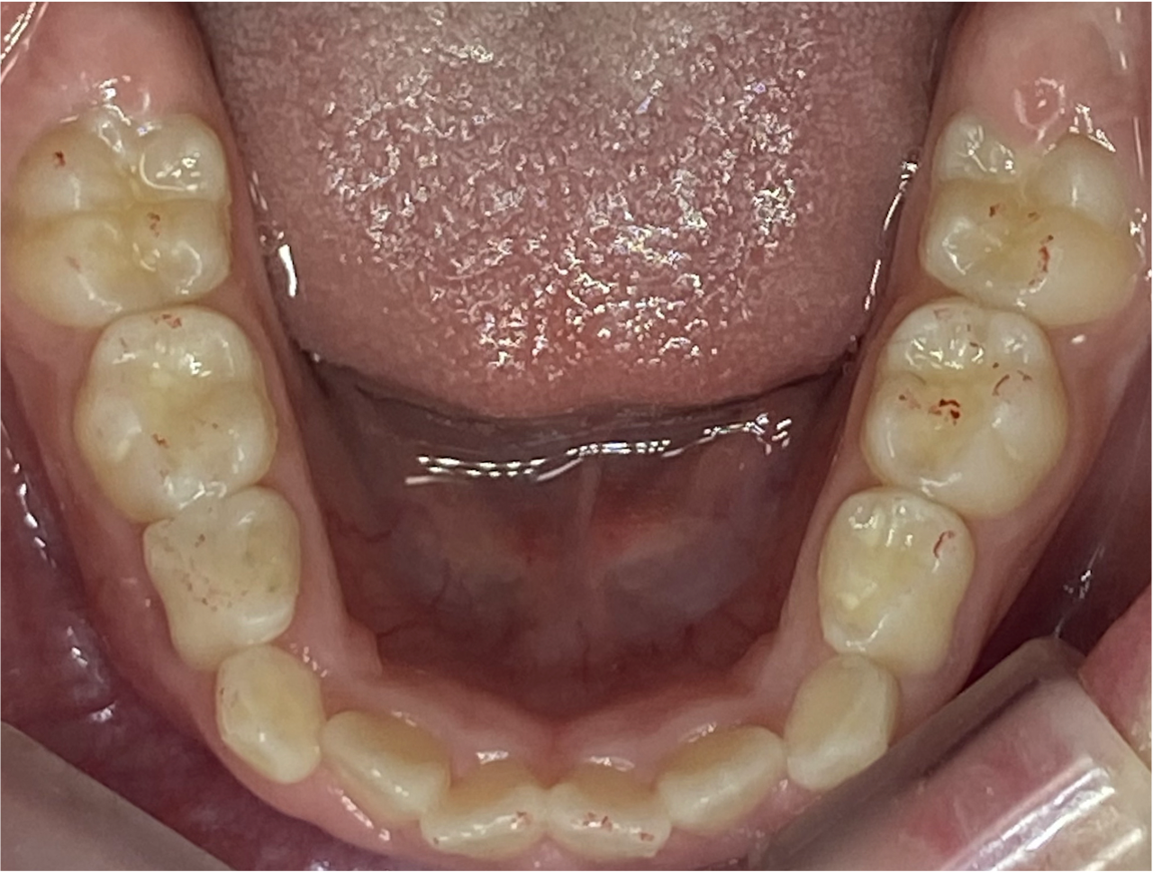 （インビザラインファースト症例）前歯が重なって生えているのが気になる
