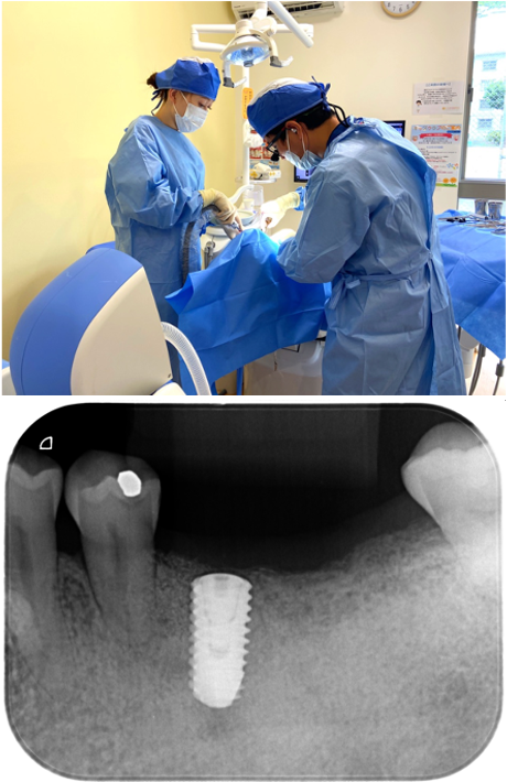 左下に歯の移植かインプラントか相談をしたい（インプラント症例）5