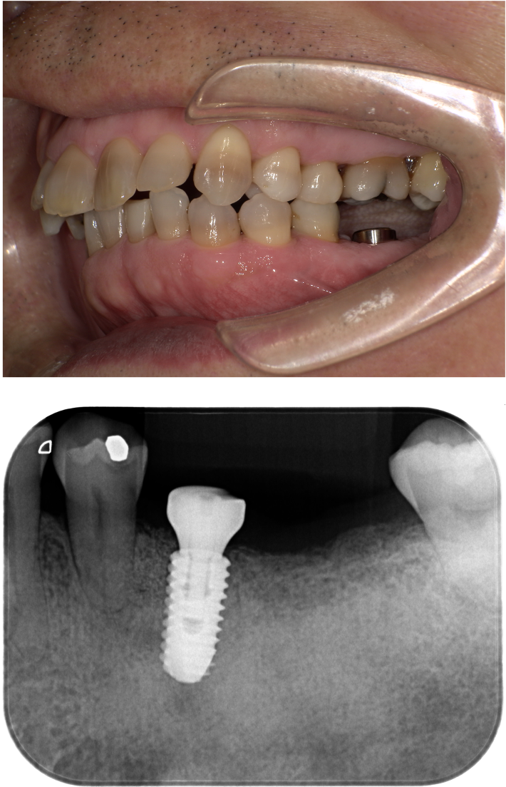 左下に歯の移植かインプラントか相談をしたい（インプラント症例）7
