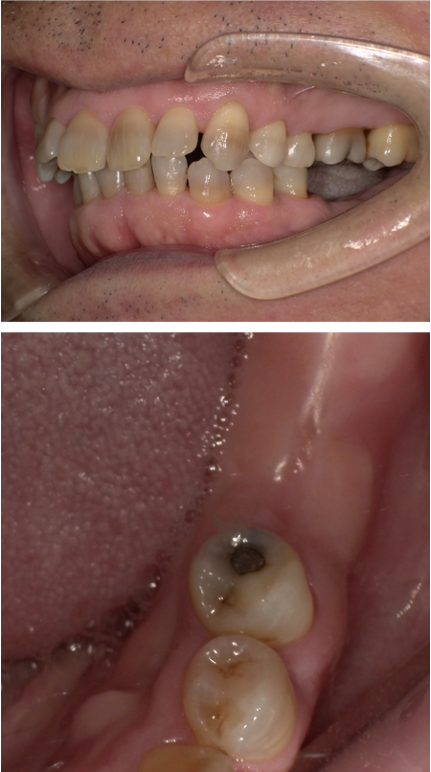 左下に歯の移植かインプラントか相談をしたい（インプラント症例）1