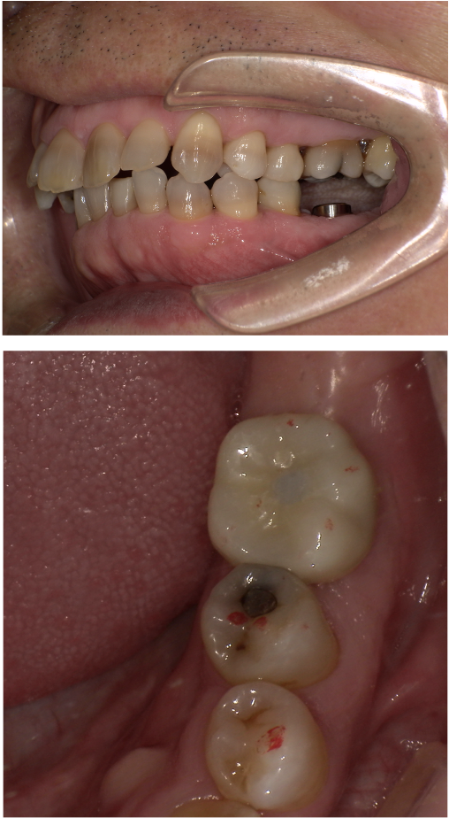 左下に歯の移植かインプラントか相談をしたい（インプラント症例）3