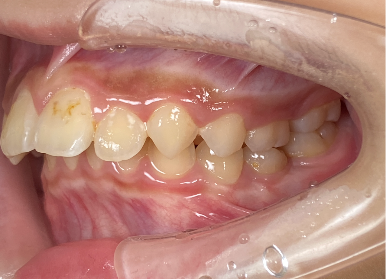 出っ歯になっているのが気になる（プレオルソ症例）