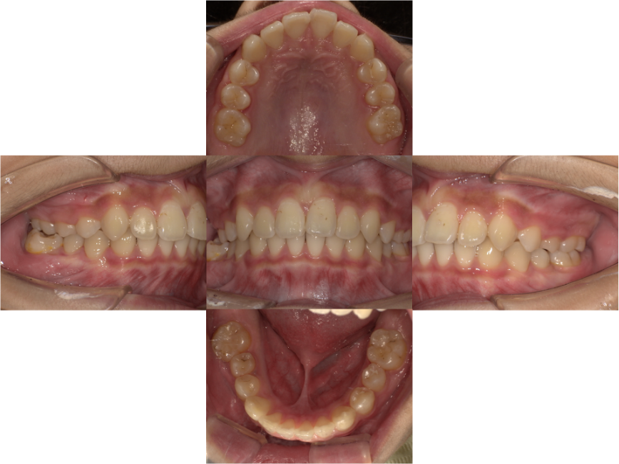 出っ歯になっているのが気になる（プレオルソ症例）3