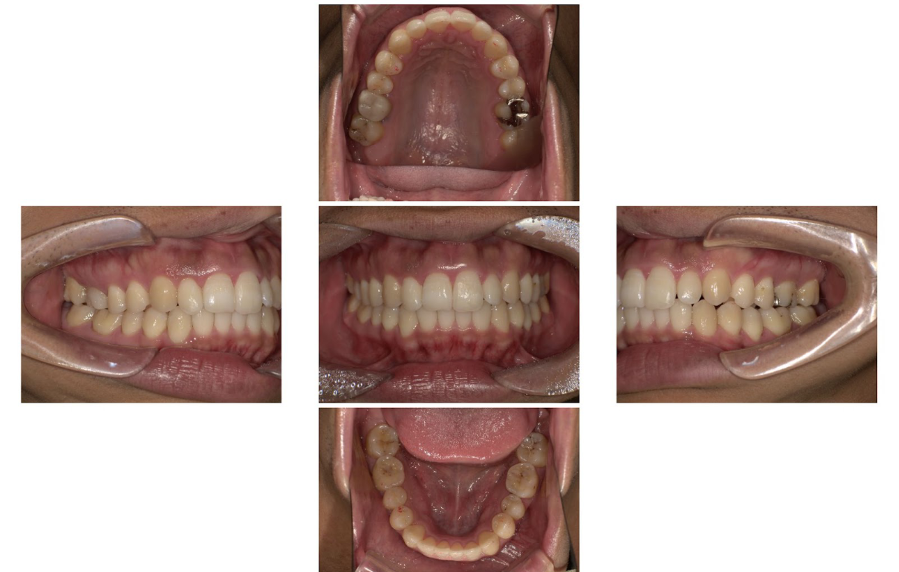 （インビザライン症例）前歯を引っ込めたい3