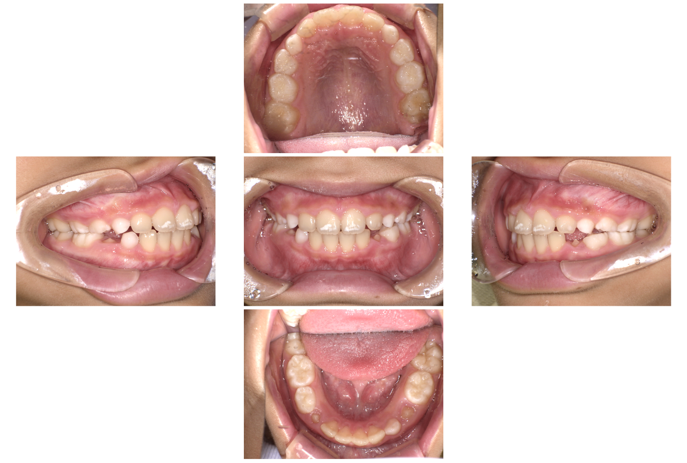 （プレオルソ症例）出っ歯をマウスピースで治したい3