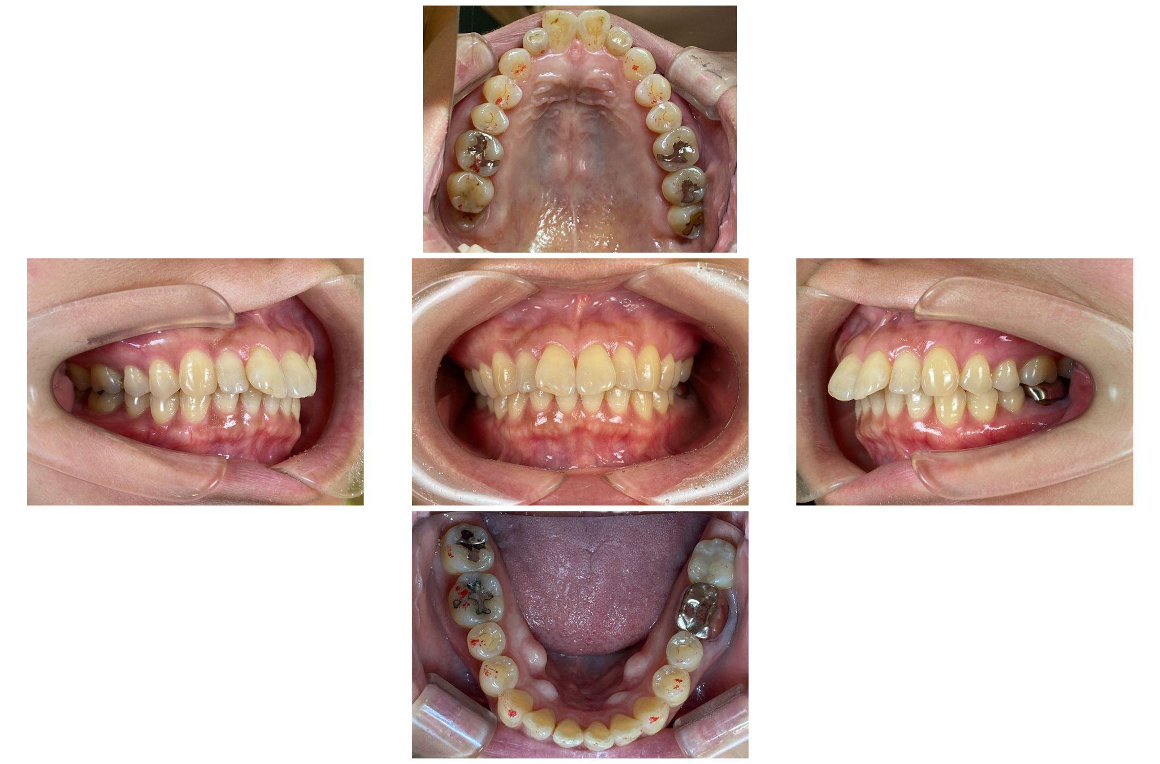 上顎前突(上の前歯が出ているのが気になる)1