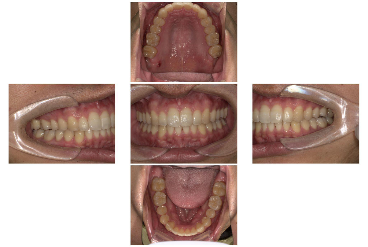 出っ歯な感じが気になっている（上顎前突症例）3