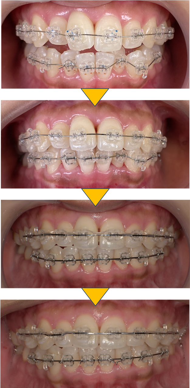 前歯のガタガタが気になる（叢生症例）：部分矯正症例5