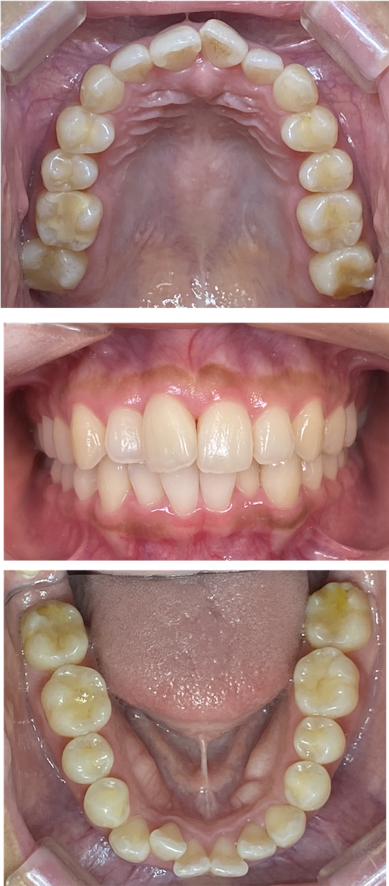 前歯のガタガタが気になる（叢生症例）：部分矯正症例1