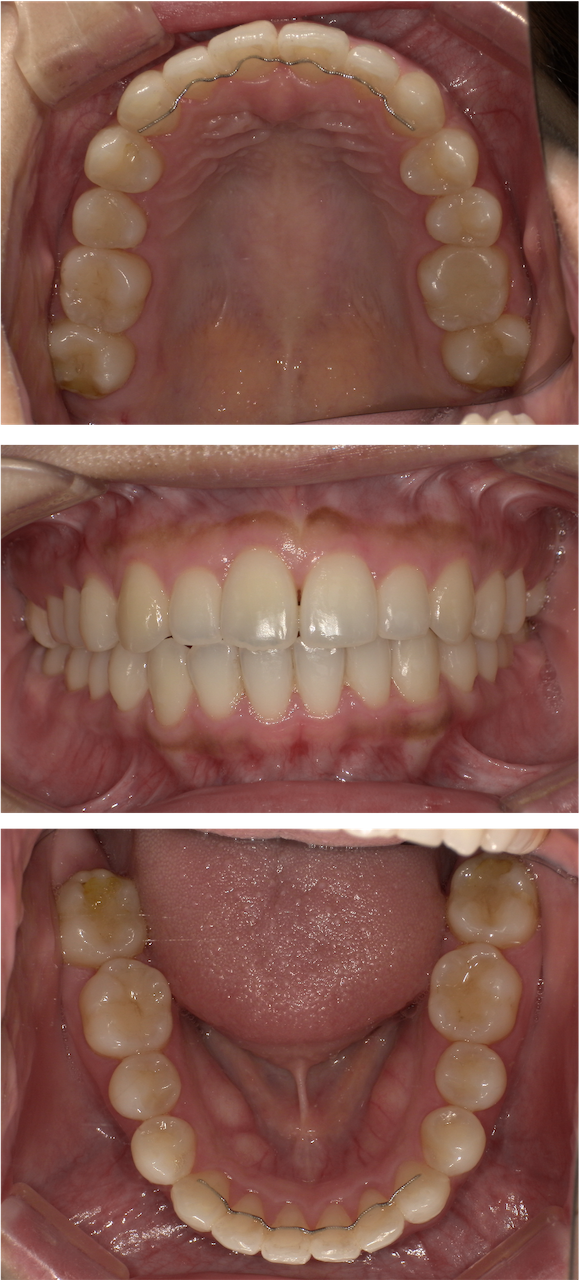 前歯のガタガタが気になる（叢生症例）：部分矯正症例4