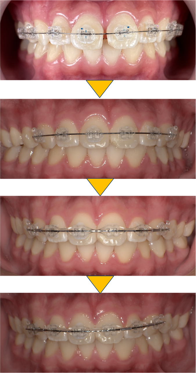 前歯のすきっ歯が気になる（部分矯正症例）5