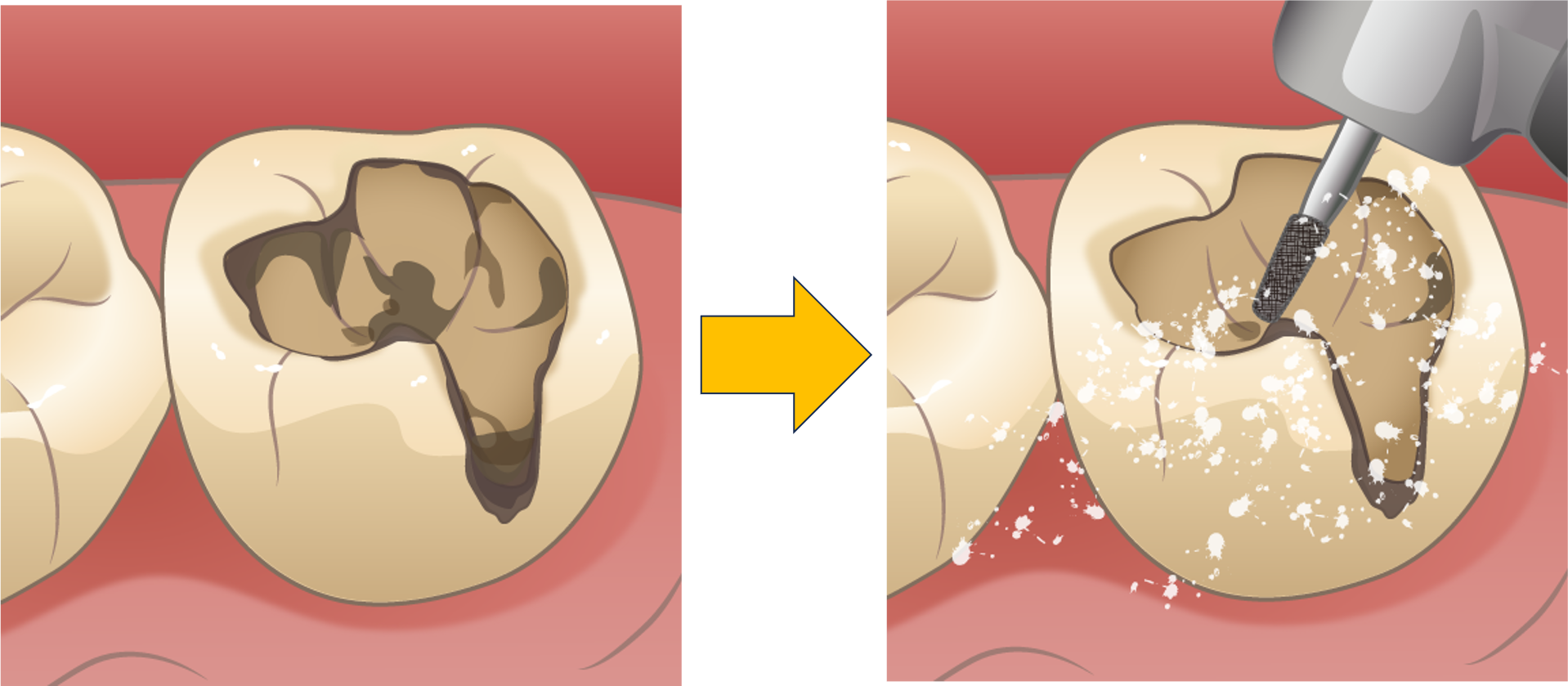 ２次虫歯（2次カリエス）とは？？7