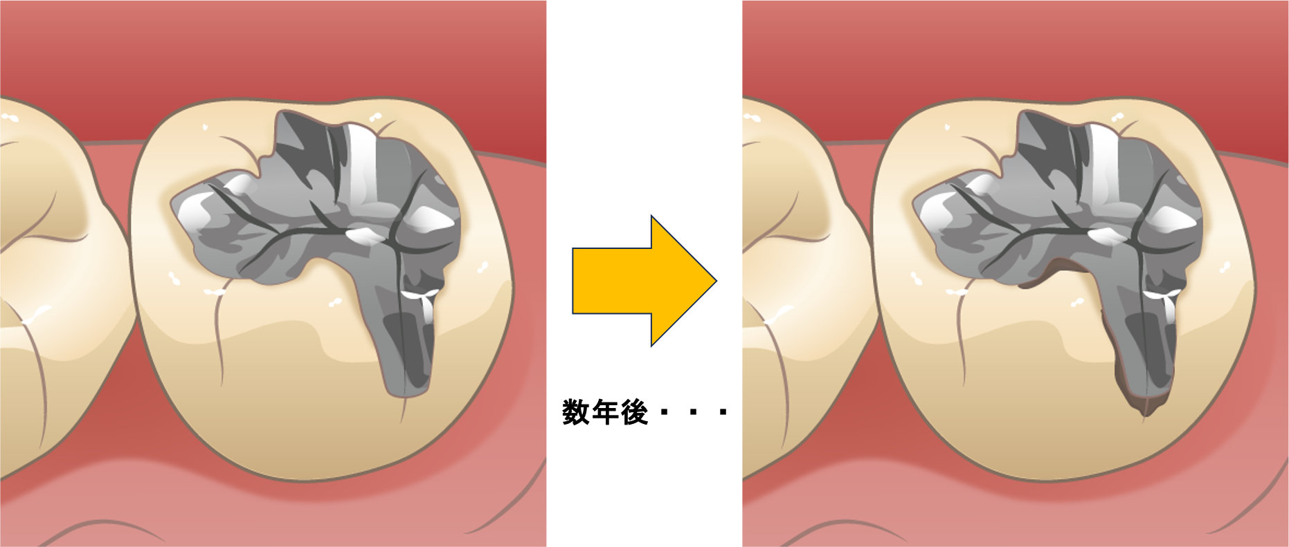 ２次虫歯（2次カリエス）とは？？5